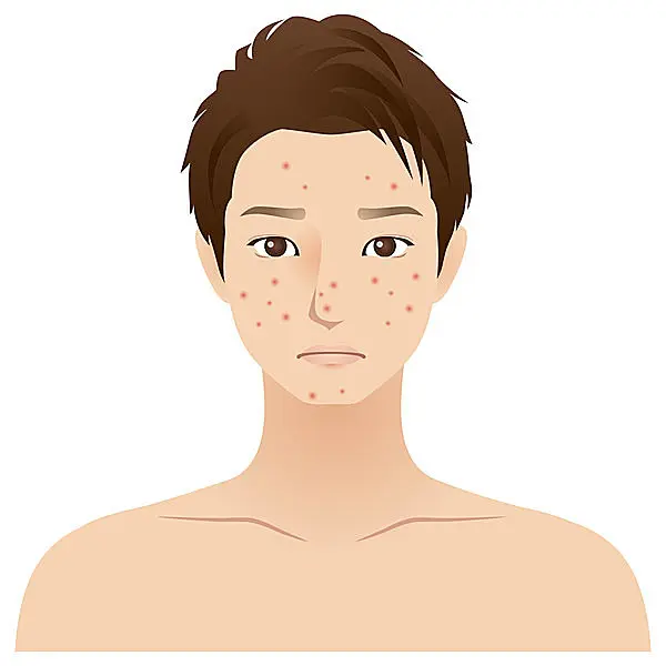 夏バテ肌 を放置したままにしていませんか 今こそ 秋口に発生する 顔カビ に要注意です Tenki Jpサプリ 15年10月04日 日本気象協会 Tenki Jp